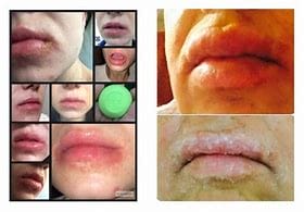 chapped lips, Top-Rated Anti-Aging Skincare Products Are Available Today! chapped lips