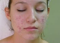 Promise Keeper Blemish Sleeping Facial, Top-Rated Anti-Aging Skincare Products Are Available Today! Promise Keeper Blemish Sleeping Facial