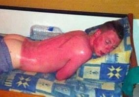 Picture of painful sunburn. Sunburn - Picture of painful sunburn.