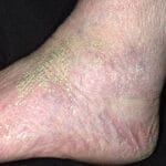 Picture of dry skin around the ankle. Dry Skin - Picture of dry skin around the ankle.