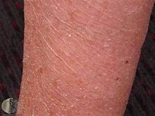 Picture of severely dry skin. dry skin - picture of severely dry skin.