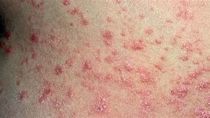 Skin Diksorders - Picture of Psoriasis Rash. Skin Disorders - picture of Psoriasis Rash.