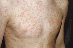 chickenpox, Top-Rated Anti-Aging Skincare Products Are Available Today! chickenpox