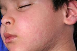 chickenpox, Top-Rated Anti-Aging Skincare Products Are Available Today! chickenpox