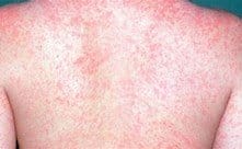 chickenpox, Top-Rated Anti-Aging Skincare Products Are Available Today! chickenpox