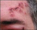 Picture of shingles on the face. Shingles treatment - picture of shingles on the face.