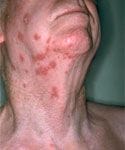Picture of shingles on the neck. Shingles treatment - picture of shingles on the neck.
